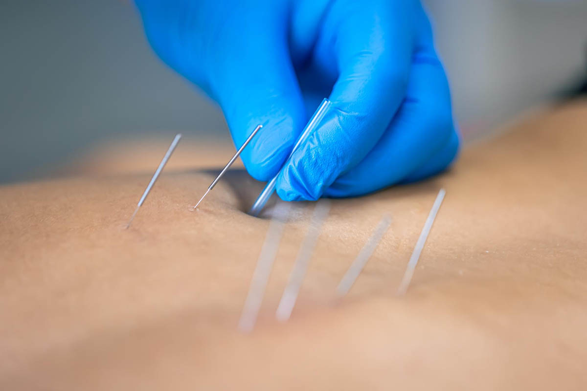 Consult Mitchell Holistic Health and Discover How Dry Needling Can Help You