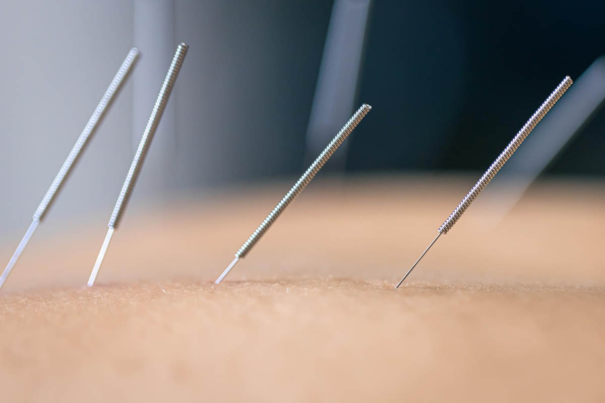 5 Health Benefits of Dry Needling