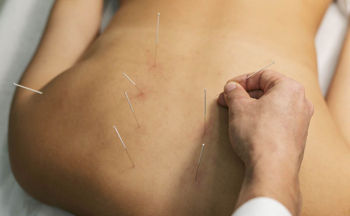 Top 5 Health Benefits of Dry Needling